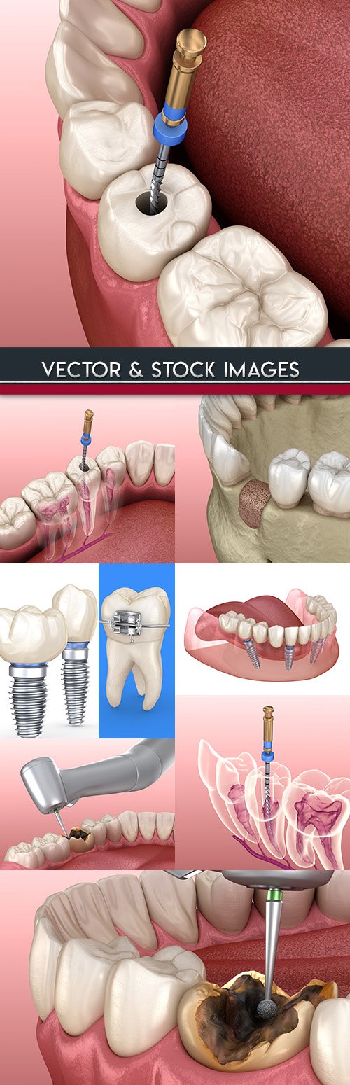 Treatment of tooth and removal nerve 3d illustration